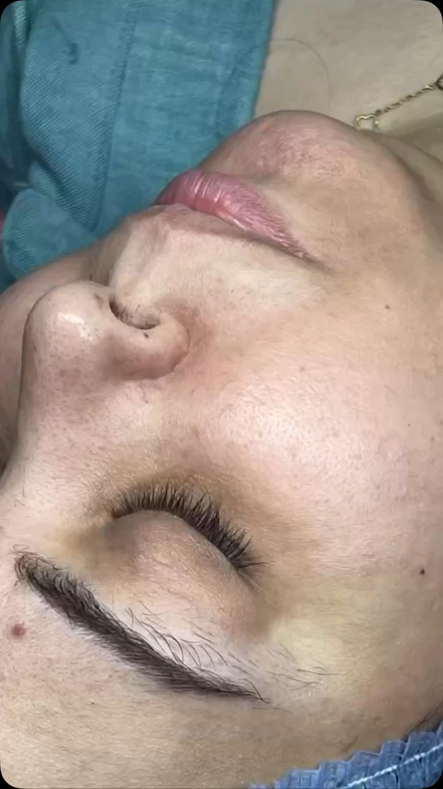 Facial, dermapen and mesotherapy in one session