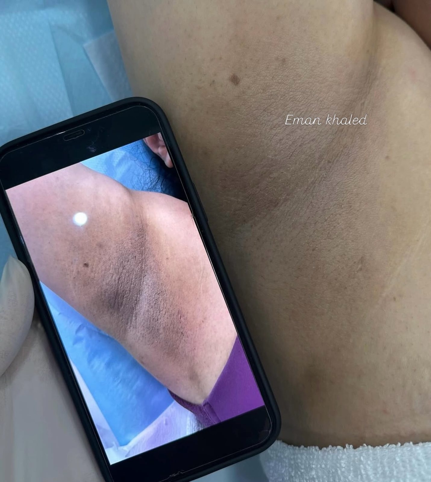 Underarm and bikini brightening with cold peel