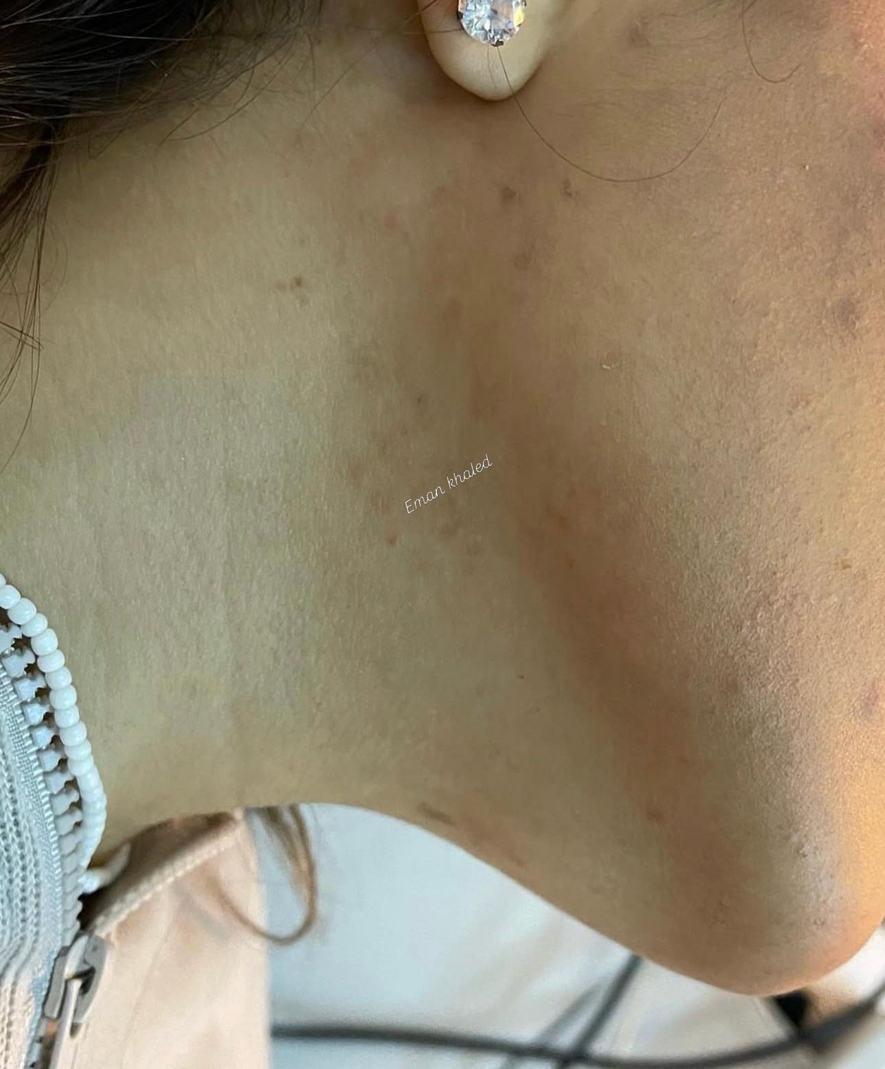 Dark spot and scar treatment sessions