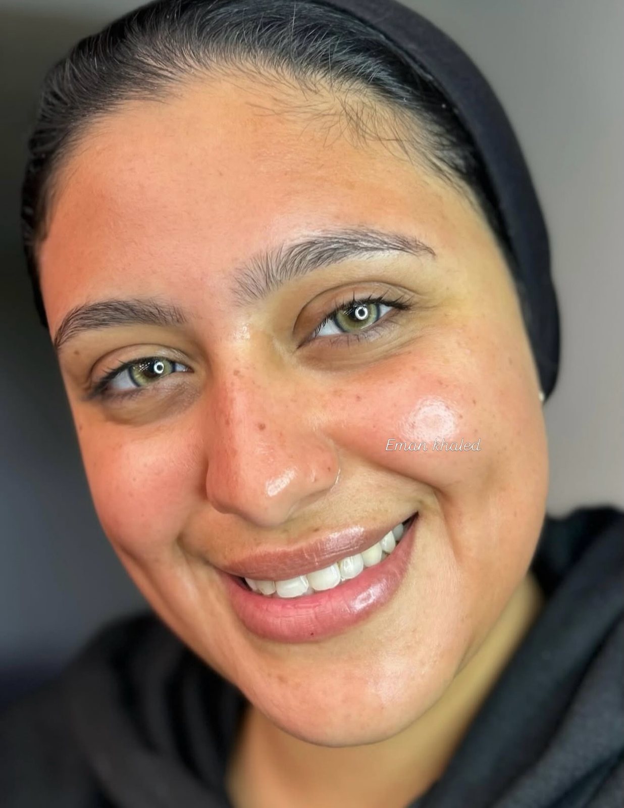 Client after a cold peel session